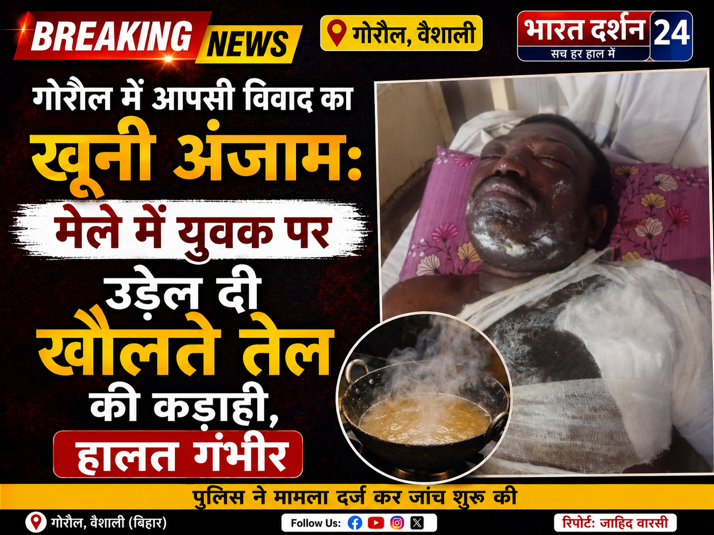 गोरौल में आपसी विवाद का खूनी अंजाम: मेले में युवक पर उड़ेल दी खौलते तेल की कड़ाही, हालत गंभीर।